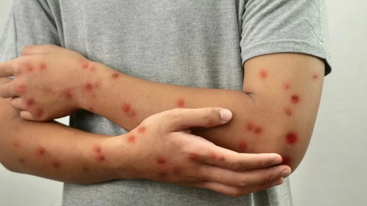 Detectan en Buenos Aires el primer caso de una variante más contagiosa de viruela del mono