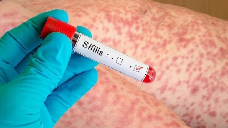 Alerta por sífilis: los casos alcanzan cifras récord en la Argentina