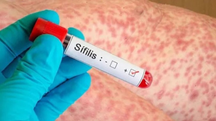 Mendoza implementa capacitaciones obligatorias para profesionales de la salud ante el aumento de casos de sífilis