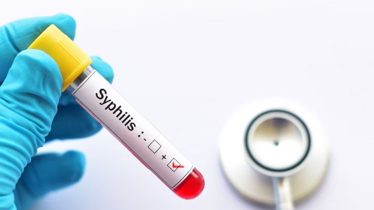 Fuerte aumento de la sífilis en Argentina: cifras históricas y alerta en salud pública